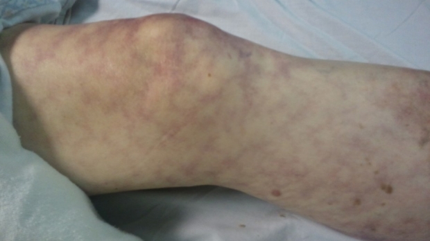 Patient has this new skin finding, what should you worry about?