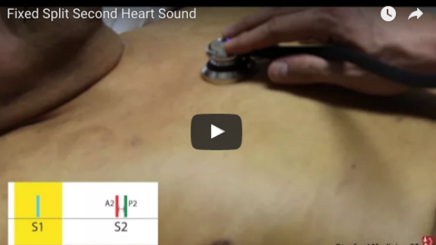 Split Fixed Second Heart Sound & Loud P2