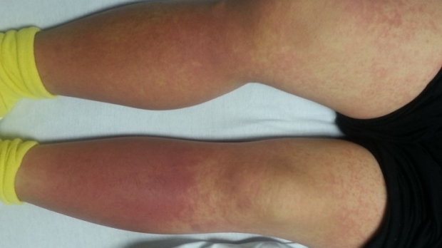 Your patient gets this rash, what’s the diagnosis?