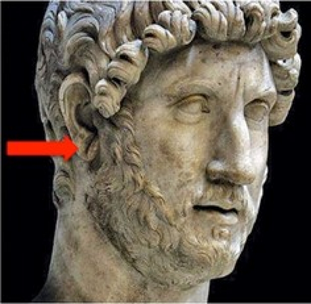 Emperor Hadrian statue with red arrow pointing to Diagonal Earlobe Crease