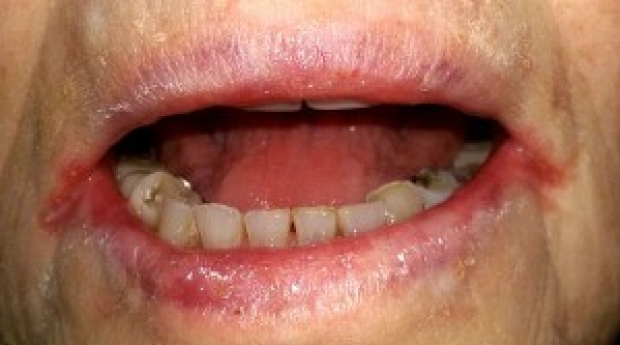 Angular cheilitis (inflammation of the corners of the mouth) in iron deficiency anemia.
