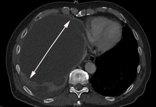 Same patient’s CT abdomen showing the large cyst in the liver cause referred pain in the shoulder.