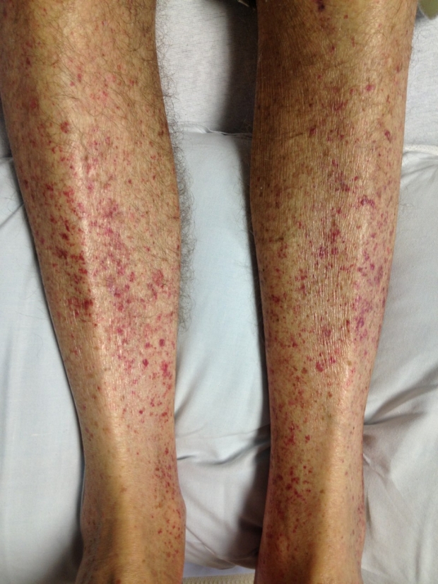 Example of Petechiae (Petechia) showing small red spots on legs