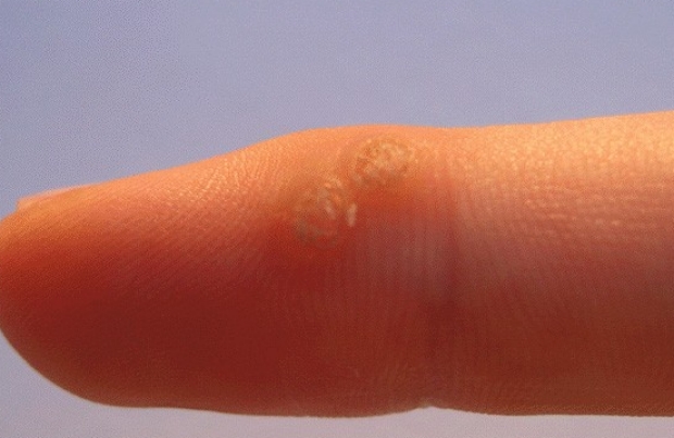 Example of skin wart on finger