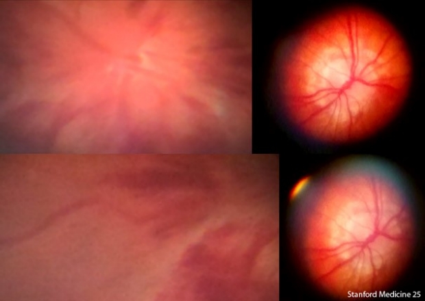 papilloedema of retina