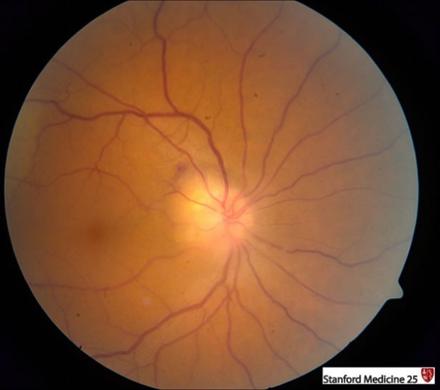 papilloedema of optic disc in retina