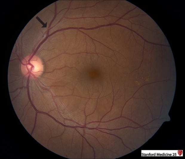 Arterial / venous nicking of retina (AV nicking)