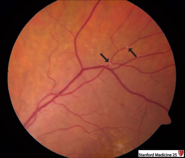 retinal emboli and infarcts