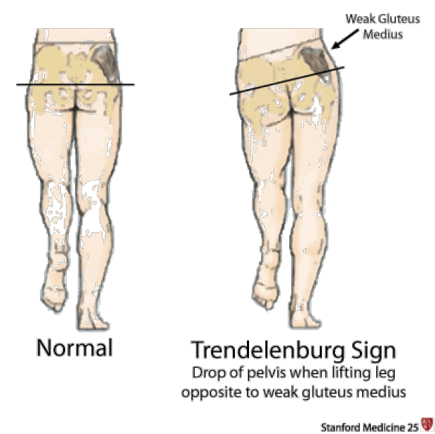 Examples of Normal Gait and Trendelenburg Sign (drop of pelvis when lifting leg opposite to weak gluteus medius)”
