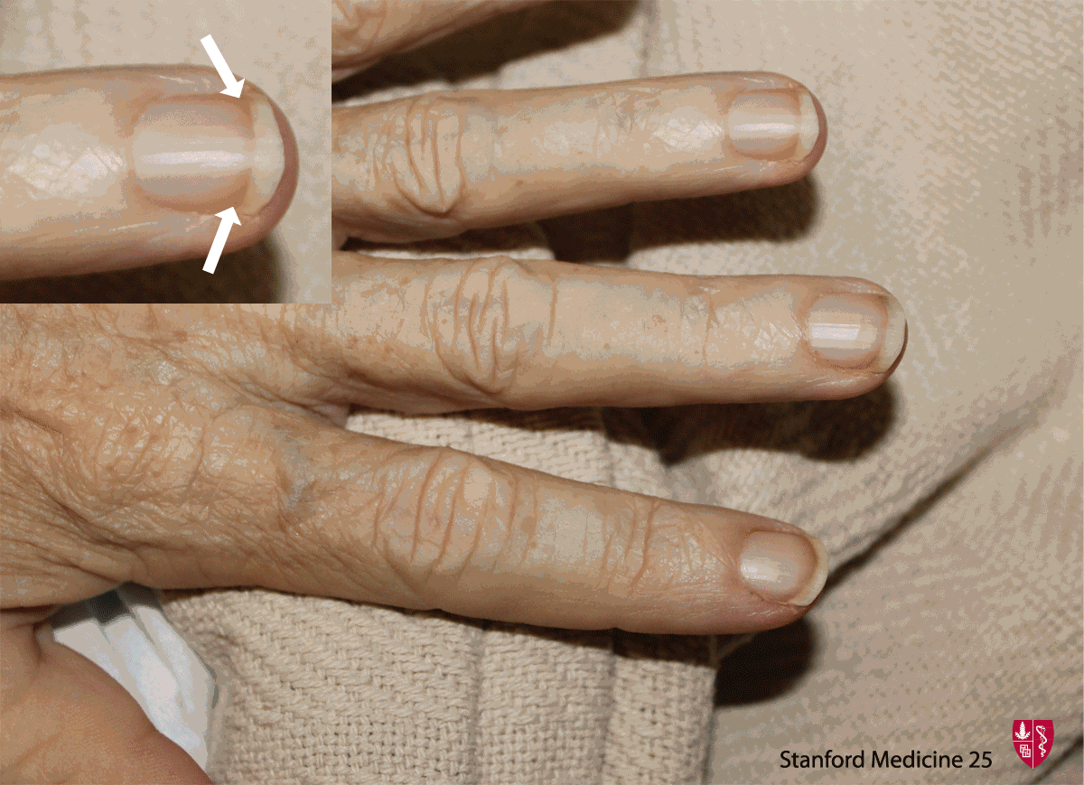 Fingernail dystrophy in a young child - Clinical Advisor