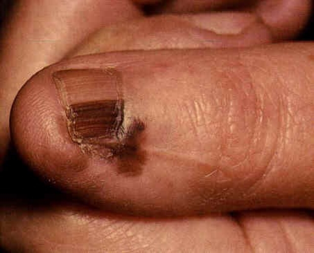 acral lentinginous melanoma
