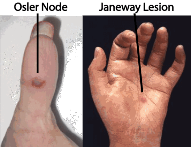 Janeway Lesion and Osler Node