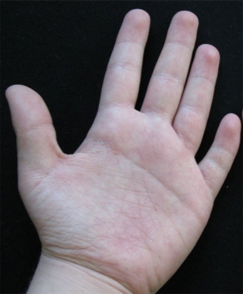 Yellow nail syndrome: a review | Orphanet Journal of Rare Diseases | Full  Text