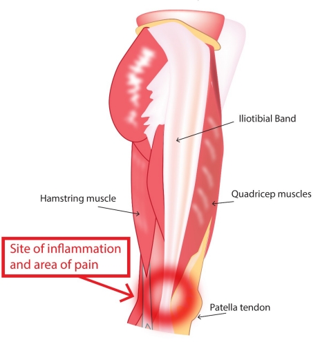 Knee Symptoms Chart