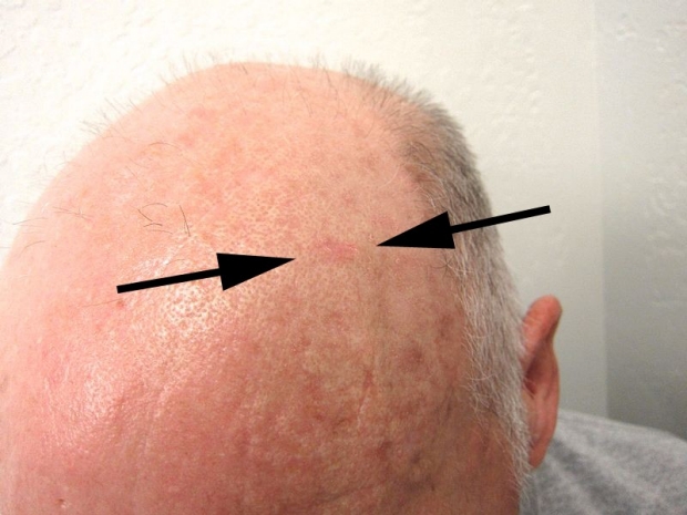 Nevi (Mole) Skin Exam | Stanford Medicine | Stanford Medicine