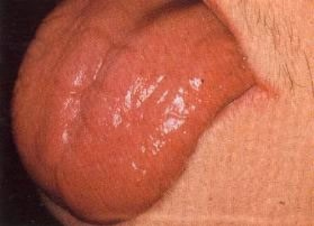 Middle of tongue split in Loftus Plastic