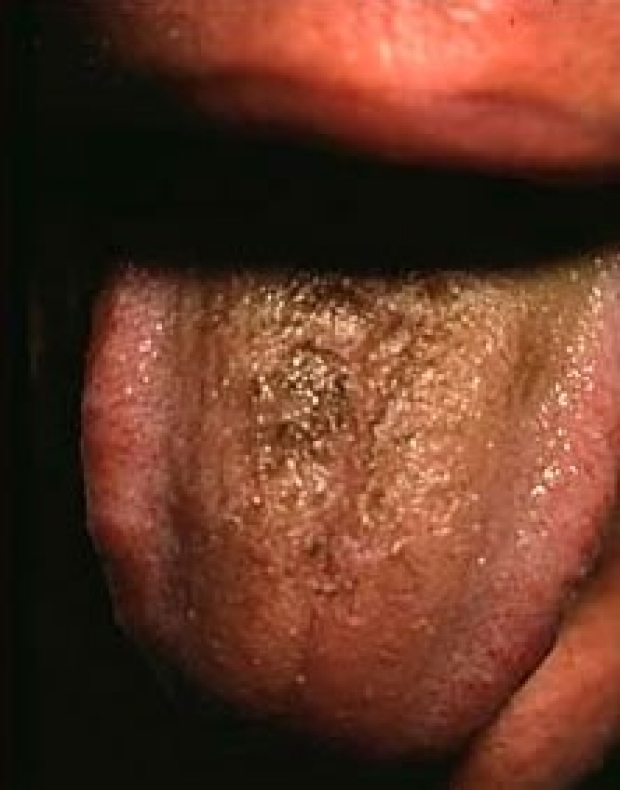 aspergillus tongue